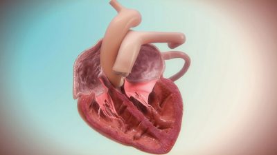 Heart animation: Mitral valve repair | Random42 Heart animation: Mitral valve repair | Random42