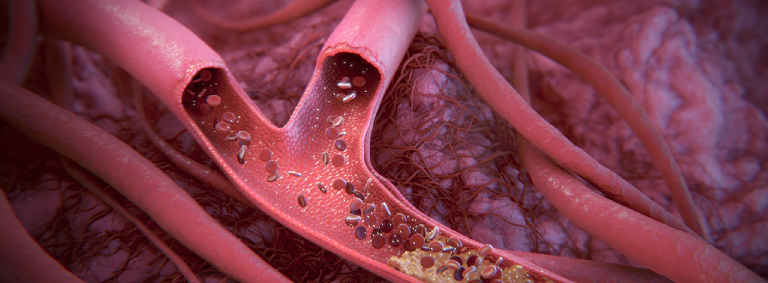 3D model of a blood vessel normal stent designed by Random42
