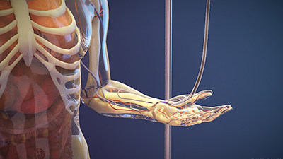 Random42 Von Willebrand Disease Virtual Reality