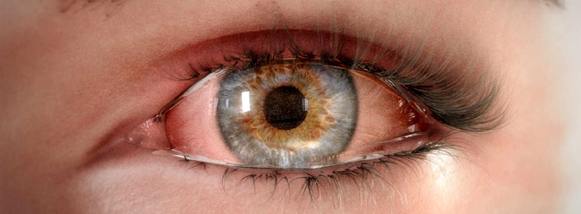 3D model of eye with dry eye disease designed by Random42