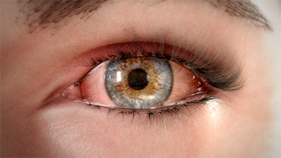 3D model of eye with dry eye disease designed by Random42
