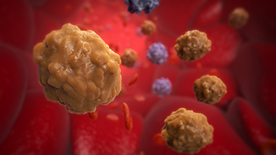 Hematologic Malignancies Interactive Game