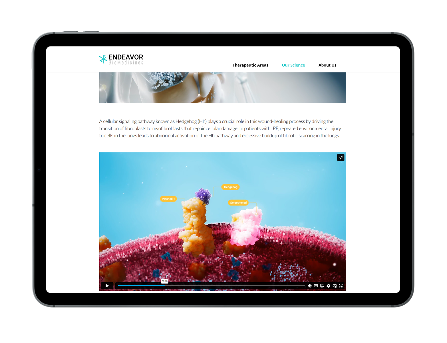 idiopathic fibrosis medical animation
